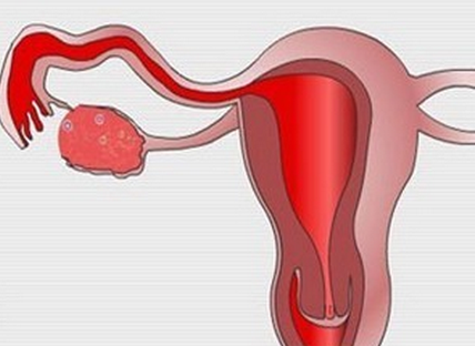 慢性输卵管炎会怀孕吗？