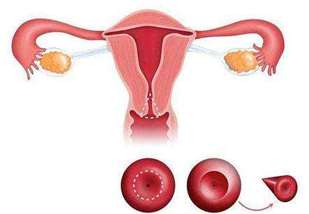 子宫内膜异位症影响生育吗？