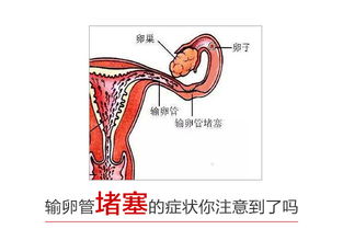 输卵管堵塞症状有哪些？