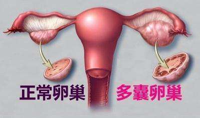 多囊卵巢综合症的病因有哪些？