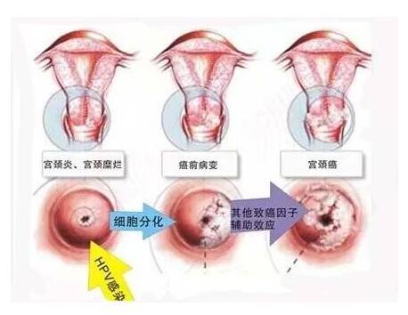 宫颈活检是什么？