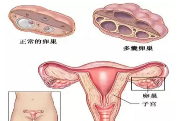卵巢妊娠术后遗症有哪些？