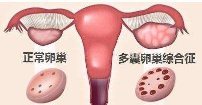 多囊卵巢治疗是指什么？