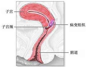 子宫颈癌发病率有多高？