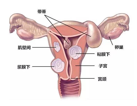 多发性子宫肌瘤，有何治疗方法呢？