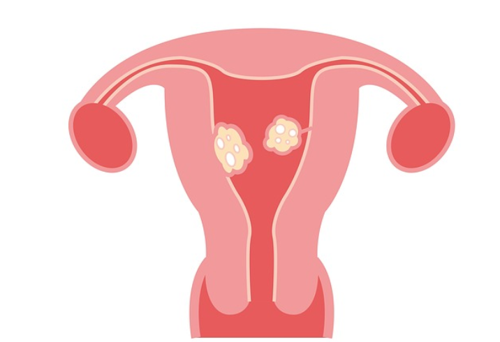 子宫肌液严重吗，如何治疗才最好？