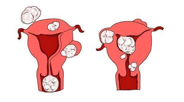 腺肌症合并子宫肌瘤能怀孕吗，附治疗缓解方法