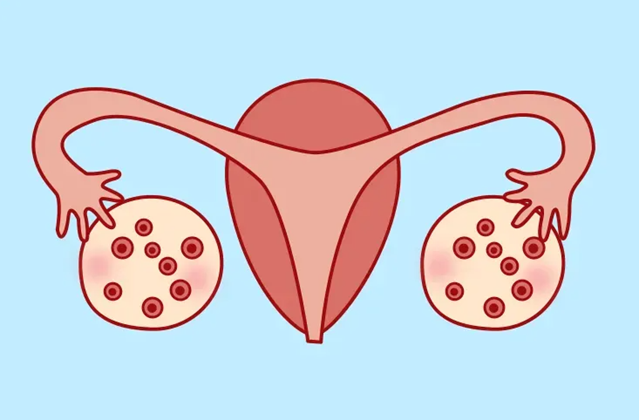 多囊卵巢综合征病人平常需要注意什么？