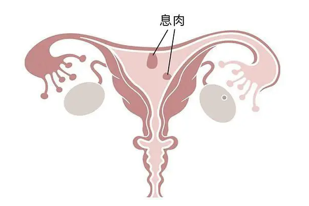 子宫肌瘤和子宫囊肿有什么不同？
