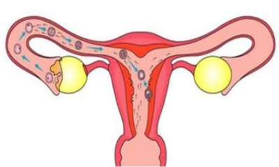 输卵管性不孕手术后能怀孕吗？