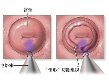 子宫破裂是什么原因？