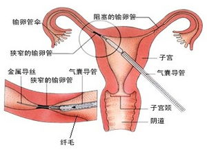 nt值为3.3mm的后果有哪些？