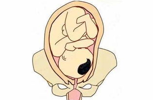 多囊卵巢容易流产吗 女性该如何保胎