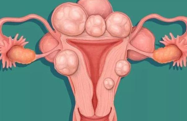 子宫腺肌瘤和子宫肌瘤的区别是什么？