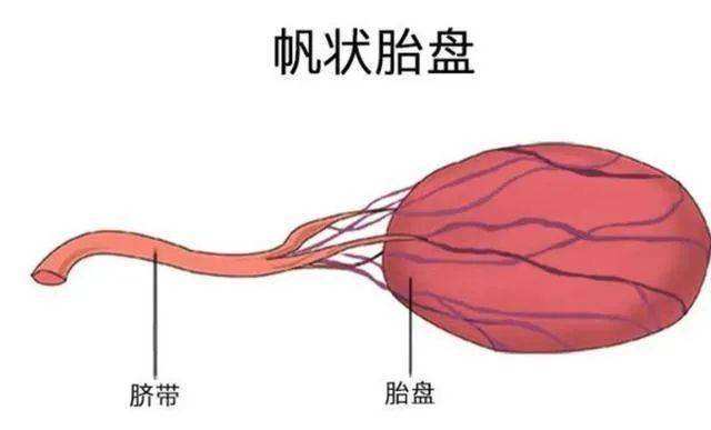 脐带帆状附着应该怎么办？