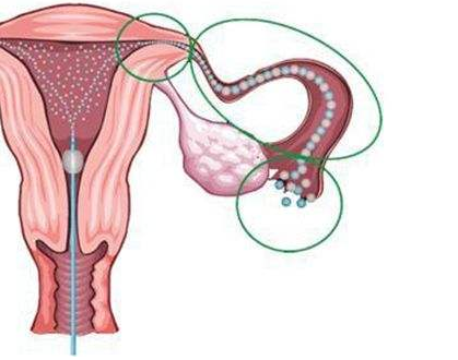 输卵管通水后多久才能怀孕？