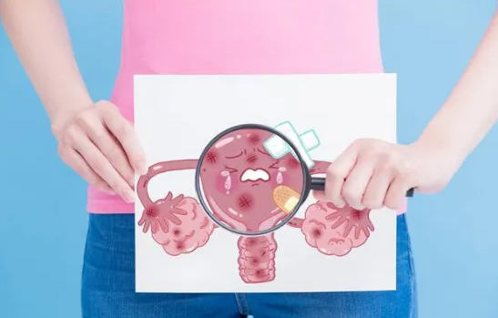 孕中期检查出盆腔积液需要保胎吗？