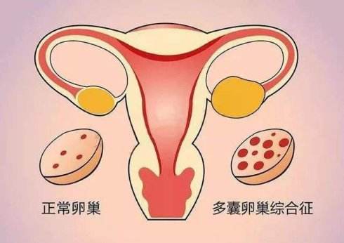 多囊卵巢可以正常受孕吗？