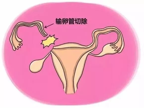 一侧输卵管切除怀孕几率有多大？