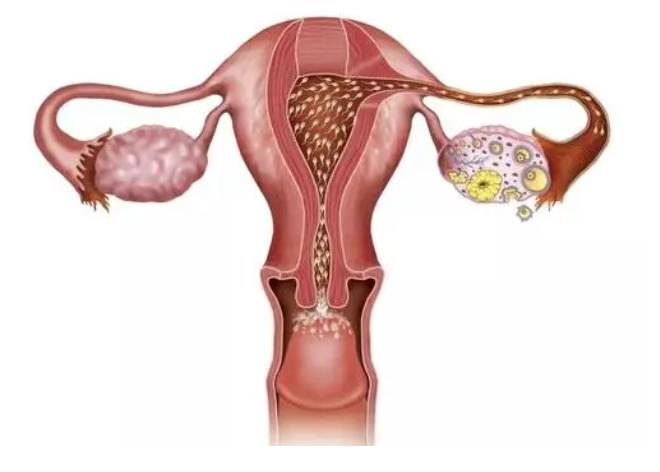 卵巢多囊是怎么造成的？
