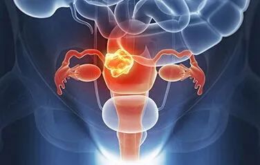 什么是卵巢囊肿？