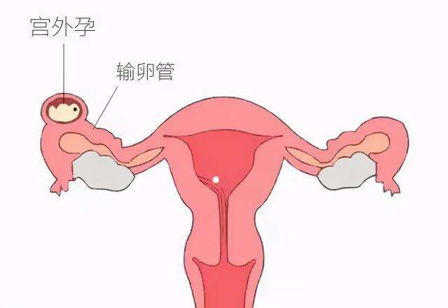 宫外孕有什么症状图片